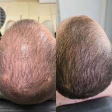 Folium Pro™ - Sistema Clínico de Terapia Láser LLLT para Regeneración Capilar