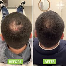 Folium Pro™ - Sistema Clínico de Terapia Láser LLLT para Regeneración Capilar
