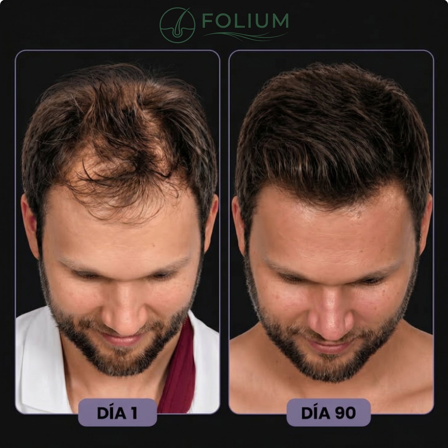 Folium Pro™ - Sistema Clínico de Terapia Láser LLLT para Regeneración Capilar