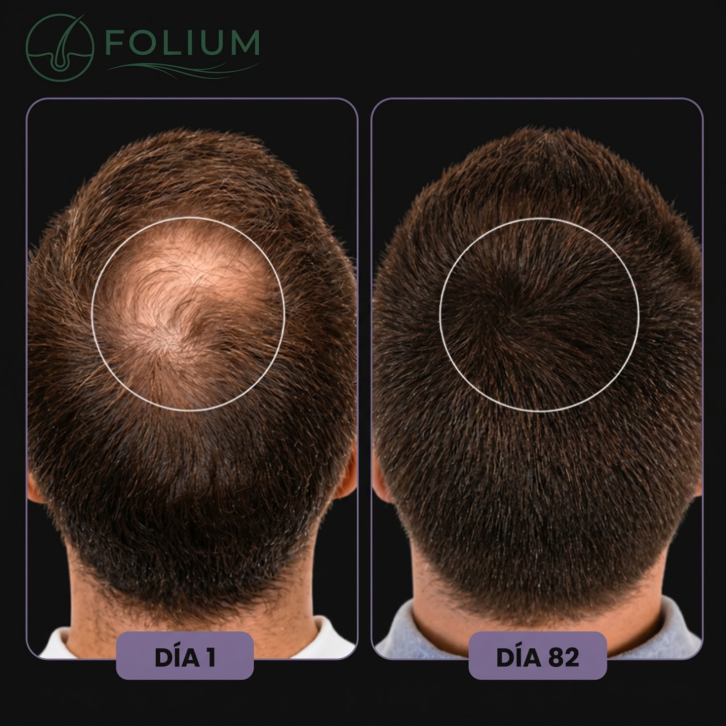 Folium Pro™ - Sistema Clínico de Terapia Láser LLLT para Regeneración Capilar
