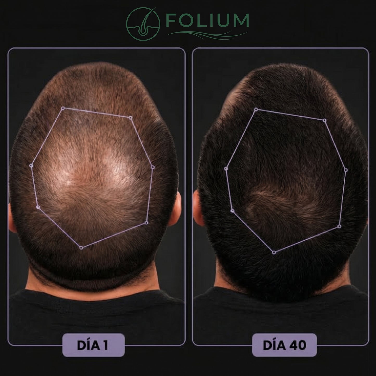 Folium Pro™ - Sistema Clínico de Terapia Láser LLLT para Regeneración Capilar