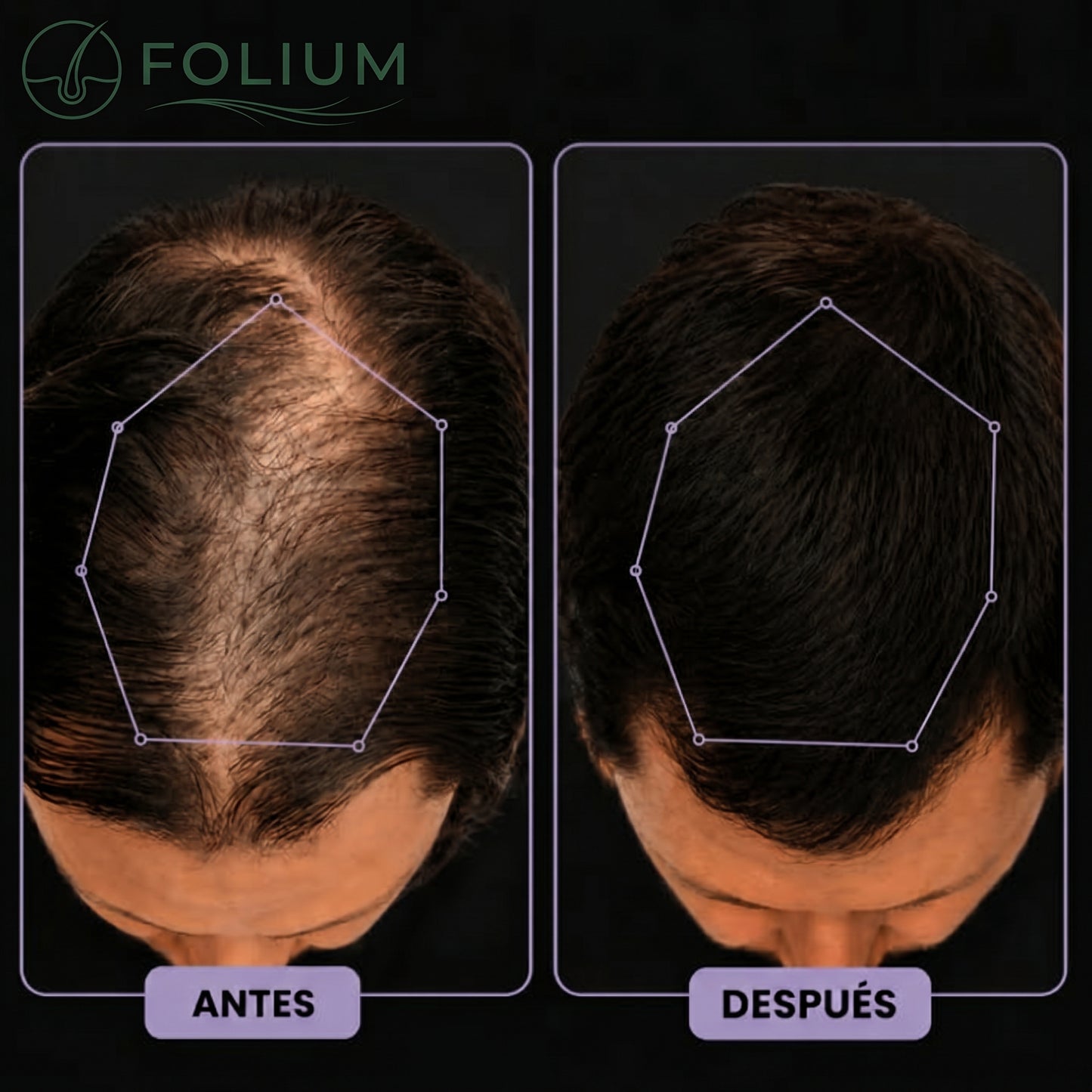 Folium Pro™ - Sistema Clínico de Terapia Láser LLLT para Regeneración Capilar