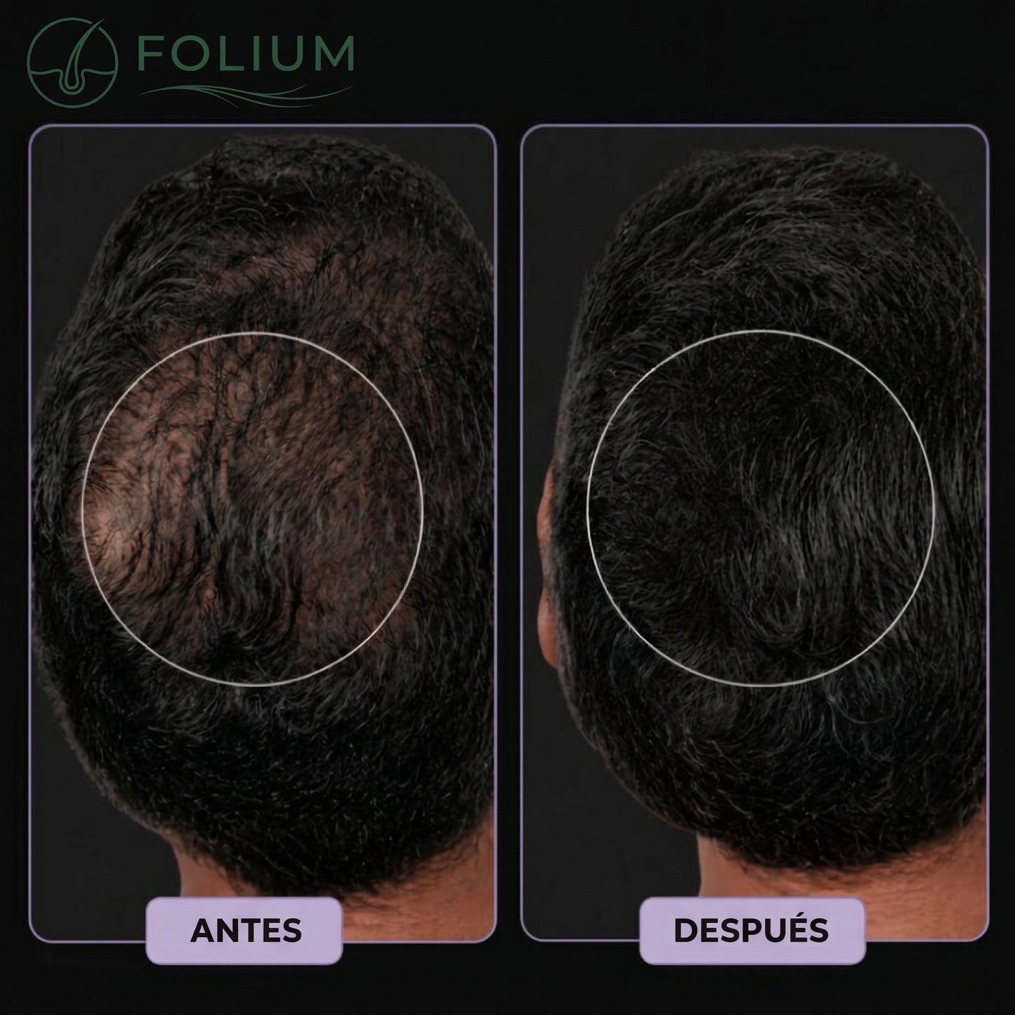 Folium Pro™ - Sistema Clínico de Terapia Láser LLLT para Regeneración Capilar
