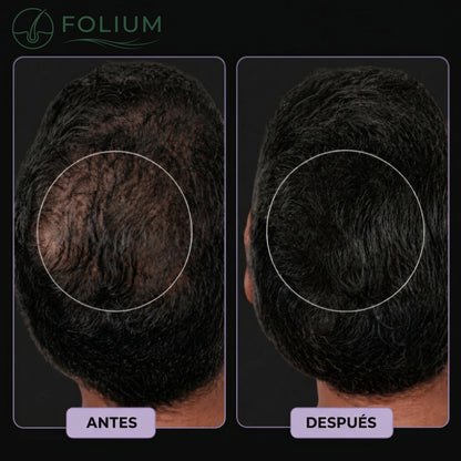 Folium Pro™ - Sistema Clínico de Terapia Láser LLLT para Regeneración Capilar